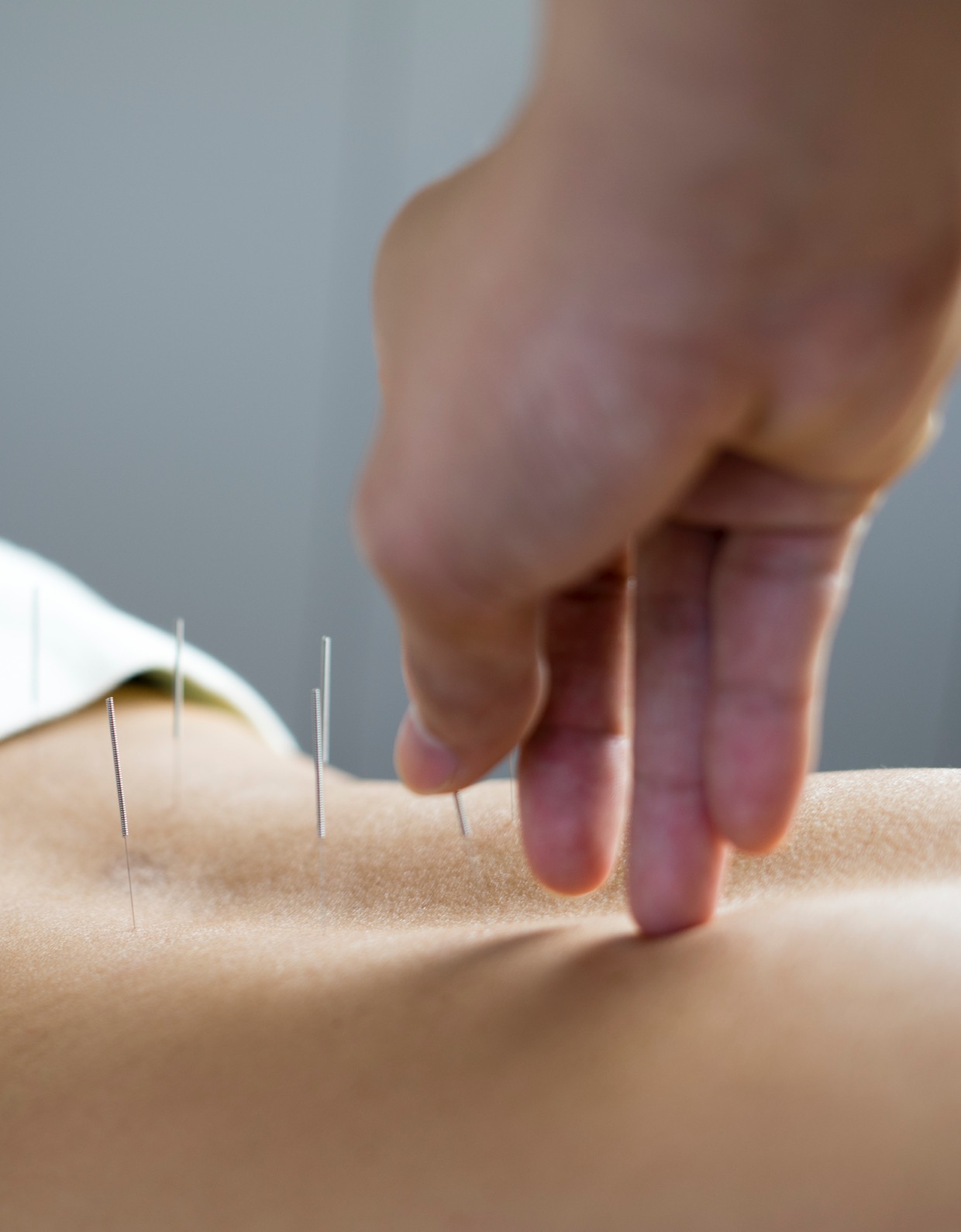 Acupuncture – treatment of pain and injuries at the Foundry Clinic